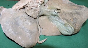 Figure from article: Anatomical Variations of...